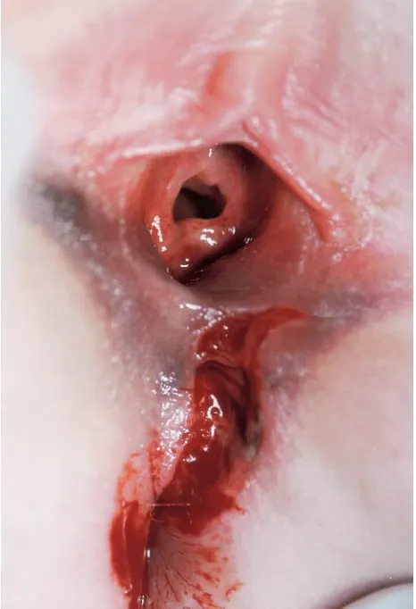 Fig 1. Case 1: Midline splitting injury from inline skating acci-dent—8-year-old girl.