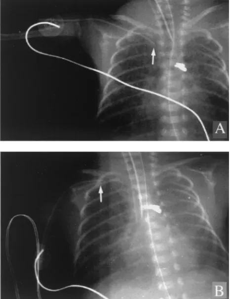 Fig 2. Catheter tip movements induced by changes in upper extremity position. Group 1, adduction of the arm with fixed elbow position;SEM