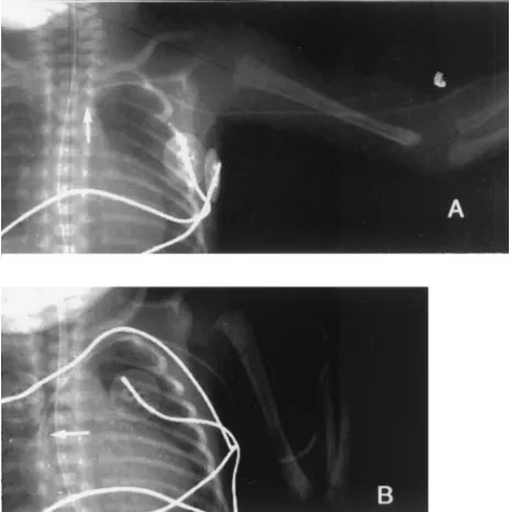 Fig 4. Catheter placed in basilic vein; maximum inward displace-ment of the tip caused by simultaneous shoulder adduction andelbow flexion from A to B.