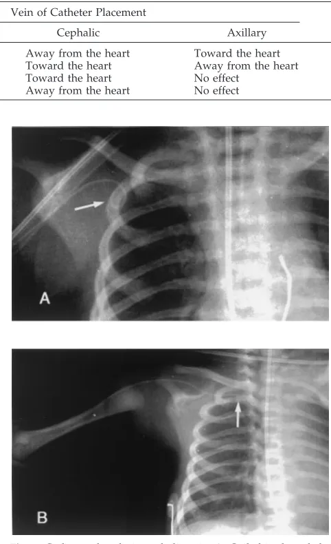 TABLE 1.Direction of the Displacement of the PICCs Related to Various Movements of the Upper Extremity