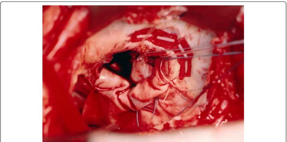 Figure 5 Thoroughly debrided posterior mitral annulus covered with an equine pericardial patch