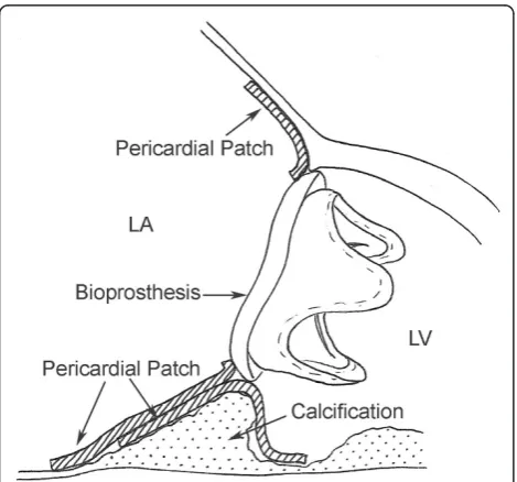 Figure 6 The bioprosthetic valve sewn to an equine pericardial patch as a collar