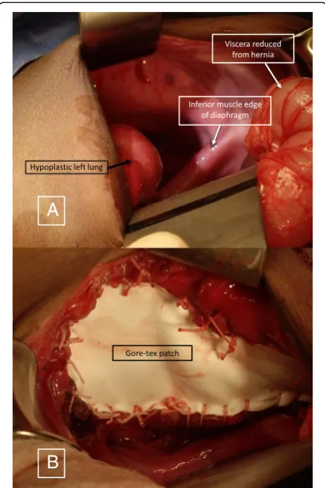 Fig. 9 a Left sided diaphragmatic hernia showing the hypoplastic leftlung, inferior muscle edge of the diaphragm and reduced viscera.b Prosthetic patch – Gore-Tex patch used to close the defect
