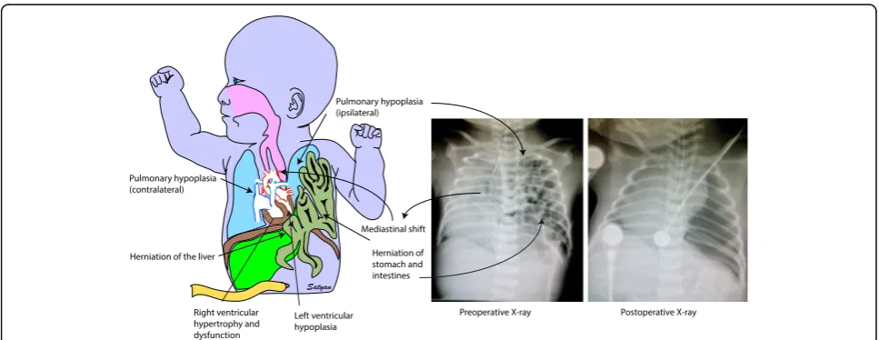 Fig. 3 Anatomical and radiological features of CDH – A defect in the diaphragm causes the abdominal viscera to herniate into the thoraciccavity