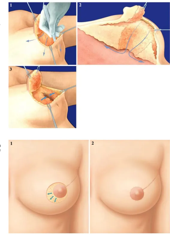 FIG. 2 Level I OPS: nipple recentralization. 1 A skin crescent is deepithelialized opposite to the lumpectomy bed in the  upper-outer quadrant