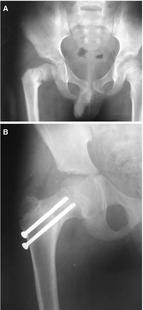 Fig. 2 a Anteroposterior radiograph (preoperative) of pelvis withboth hips showing a 15-day-old type 2 fracture of right-sided femoralneck