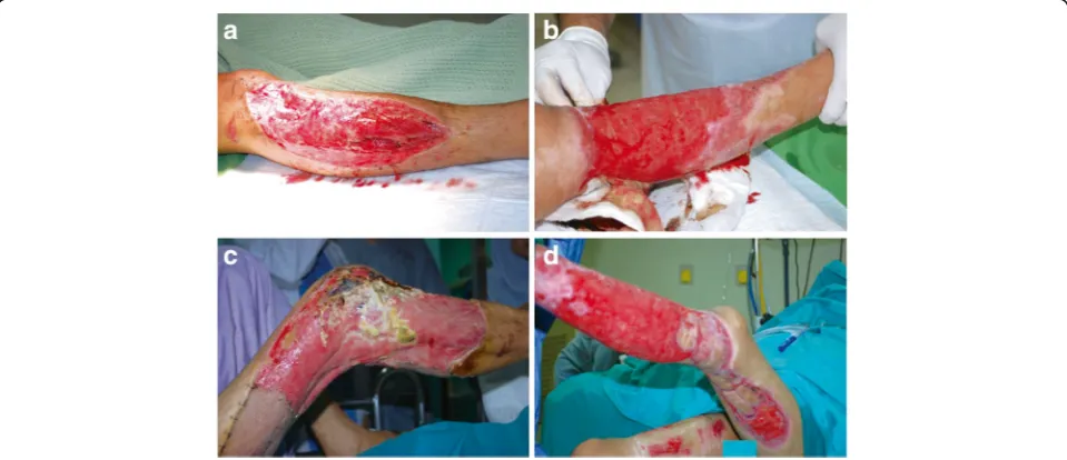 Fig. 3 Major skin injuries including 3rd degree skin wounds where the whole skin has been lost that require a graft or tissue-engineered substituteburns;(Courtesy of the Tissue Engineering Centre National University of Malaysia Medical Centre)