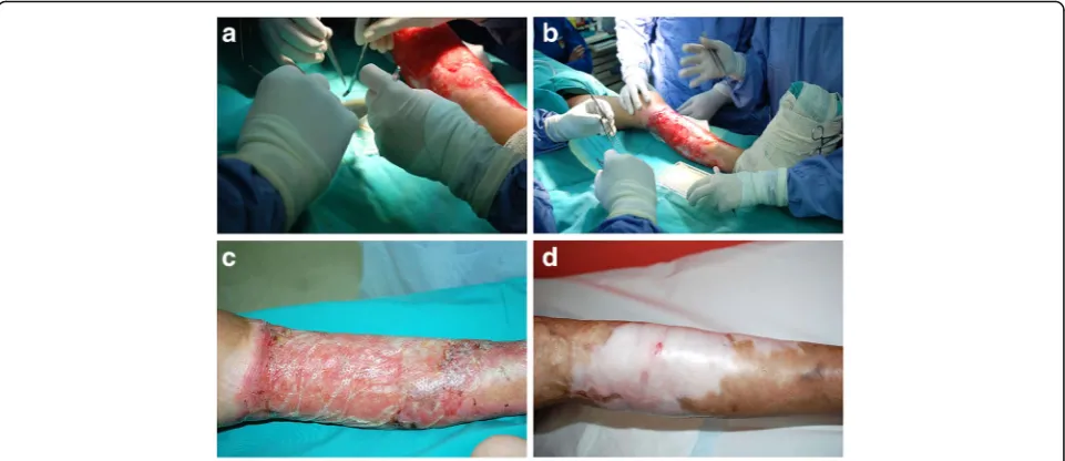 Fig. 6 Bi-layered tissue engineered skin (MyDerm) [by the Cell Tissue Technology Company from Malaysia in collaborationwith the Tissue Engineering Centre, National University of Malaysia32–34] (producedMedical Centre, Malaysian patent application No