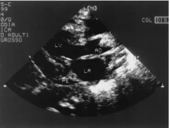 Fig 1. Parasternal long-axis view of the left ventricle. The ascending aorta is completely obstructed by the thrombus (ogive-shapedimage)