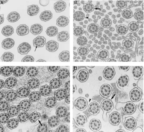 Fig 1. Various main ultrastructural defects of respiratory cilia (barsshowing “9 � 0.1 �m)