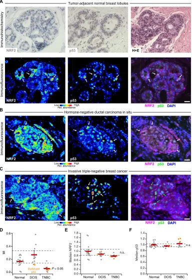Fig. 6. NRF2 and p53 are costabilized in breast epithelial tissue and prema-parison was made by Kruskal-Wallis rank sum test with Šidák correction for multi-lignant lesions but uncoupled in TNBC.(A) Immunohistochemistry (top) and im-munofluorescence (botto