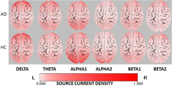 Fig. 1. Averaged eLORETA source current density in each frequency band in AD patients and healthy controls