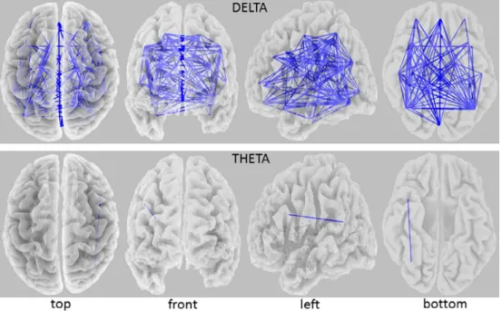 Fig. 2. eLORETA wire diagram indicating cortical regions with significantly decreased delta and theta lagged phase synchronization (threshold; t = 4.28, p < 0.05) in patients with Alzheimer’s disease compared with healthy controls
