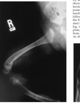 Fig 2. Right femur, September 5, 1996.