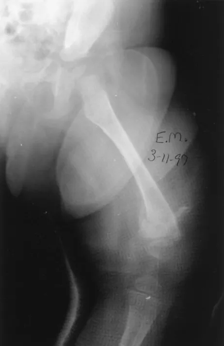 Fig 5. Left femur, March 11, 1997.