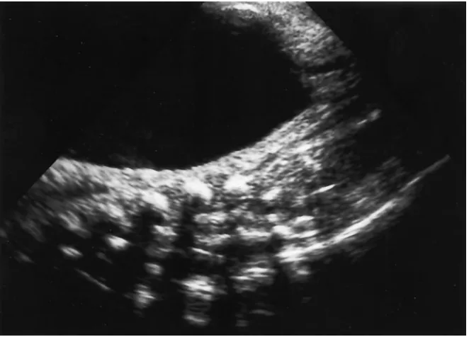 Fig 1. Case 1. Ultrasound of bladder be-fore catheterization, showing distension.