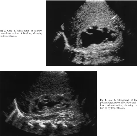 Fig 2. Case 1. Ultrasound of kidney,precatheterization of bladder, showinghydronephrosis.