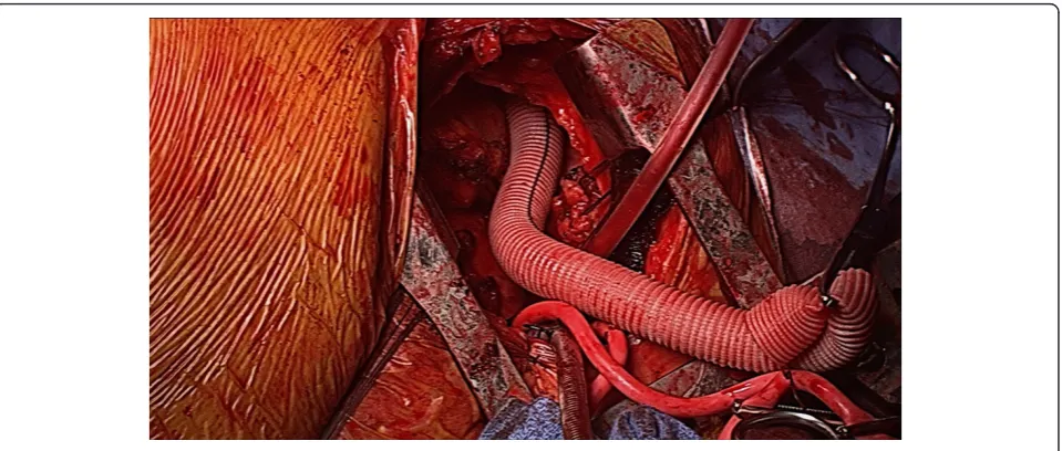 Figure 4 Intraoperative exposure of Aorta with Outflow Graft.