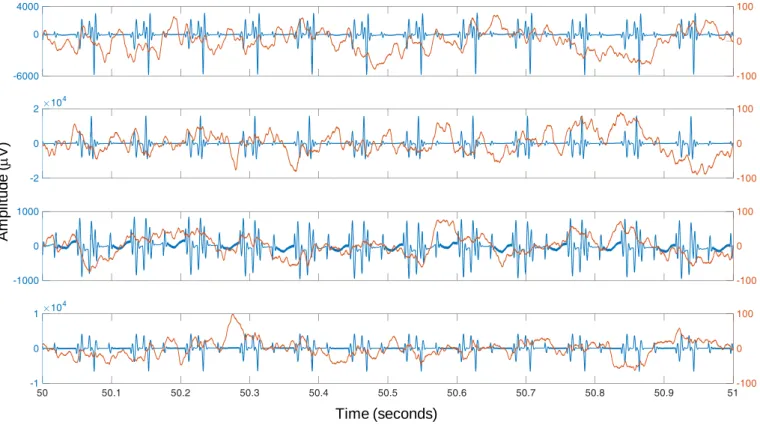 Figure 4-1 Representative icEEG time courses (Patient IH; see an illustration of the icEEG implantation scheme in Figure 4-3), before (blue) and after (orange)  the subtraction of the gradient artefact template