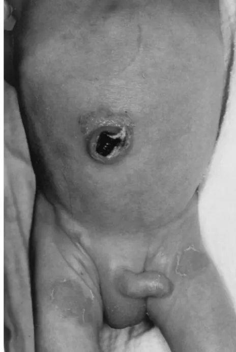 Fig 1. Skin lesions on the upper thighs with superficial epidermalpeeling and a periumbilical skin lesion with exudative erosions, 24hours after onset of disease.