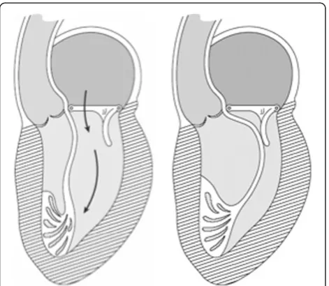 Figure 2 The MitroFix™ device in open (A) and coapting (B)position with the anterior leaflet of the MV.