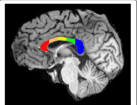 Fig. 1 The five callosal regions examined in this work, depicted insegment 3mid-sagittal cross-section: segment 1—red, segment 2—orange,—yellow, segment 4—green, segment 5—blue