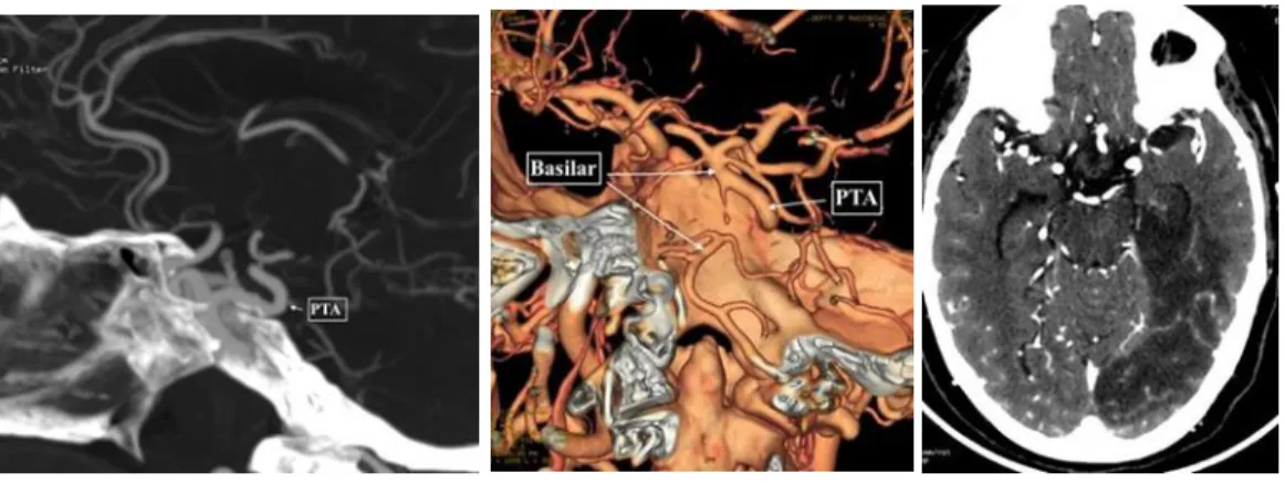 Figure 1: PTA-Acute Stroke: Axial CT head, A) showing hypodensity involving cortex and subcorticular and deep  white matter of Left PCA territory; B) PTA was seen (arrow in B) connecting cavernous RICA to basilar artery on  Maximum Intensity Projection Cor