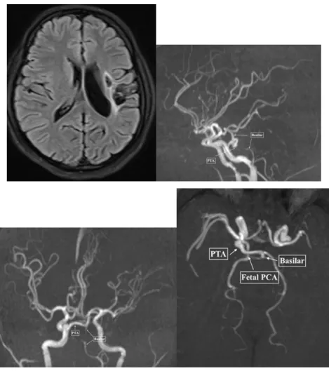 Figure  2:  PTA-Chronic  Infarct:  Axial  FLAIR,  A)  Shows  cystic  encephalom  alacic  changes  and  gliosis  in  left  insular region and frontal operculum, TOF MRA Sagittal; B) Coronal; C) and Axial; D) views demonstrating PTA  extending from Cavernous