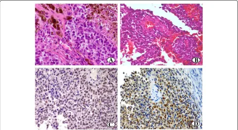 Table 3 Frequency of undifferentiated phenotype, necrosis and Ki-67 proliferation index in tumors with and without Bmi-1 expression