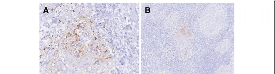 Fig. 1 a PD-L1 expression in breast cancer cells. See the membrane staining (200X). b Lymph node with PD-L1 positive metastatic breast cancercells (100X)