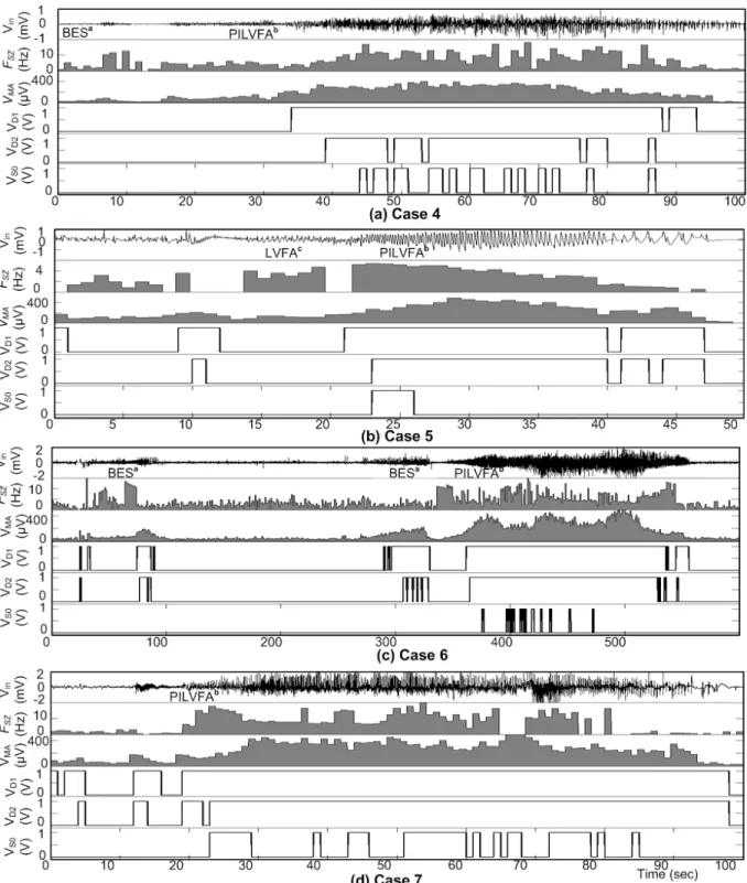 Figure  2-11:  IcEEG  analysis  and  seizure  onset  detection  using  Matlab.  The  icEEG  (V in )  of  a  seizure recorded using two contacts from the EZ, frequency analysis F SZ , mean absolute amplitude  analysis V MA , the high frequency detections V 