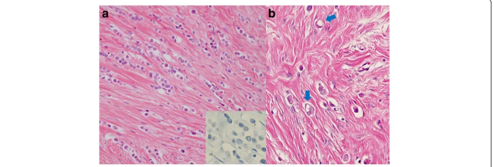 Fig. 1 Pathological findings of primary breast cancer.negative) are arranged in slender strands (Hematoxylin and eosin staining (HE), × 400)