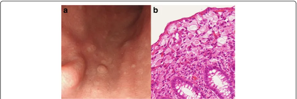 Fig. 4 Multiple metastatic gastric polyps. Gastrointestinal fiberscopy revealed multiple small white elevated polyps in the stomach (a), which had notbeen seen at the time of the initial diagnosis of recurrent disease of the colon