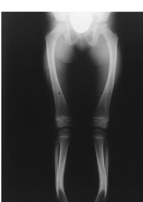Fig 2. Rachitic radiographic features in long bones of legs in Case 1.Widening of long bones