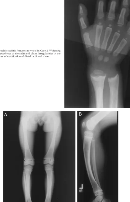 Fig 5. Radiographic rachitic features in wrists in Case 2. Wideningof the distal metaphyses of the radii and ulnae