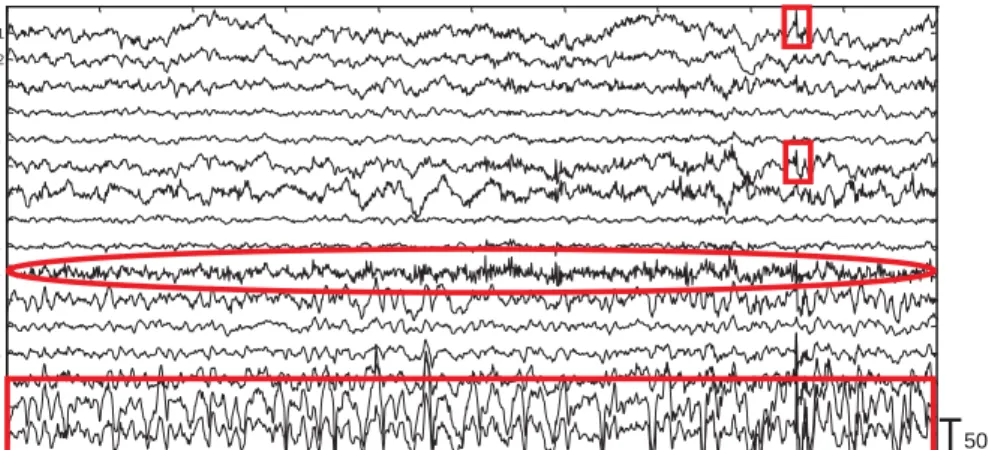 Fig. 5. Performance of the algorithm on ictal EEG 
