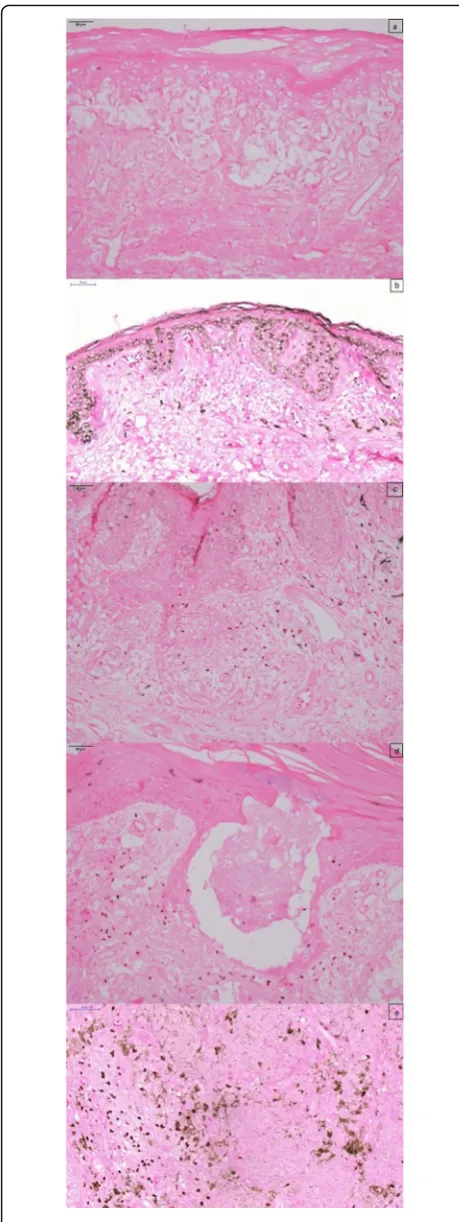 Fig. 2 Positivity to FOXP3 immunostaining contra-colored byGiemsa, 400× Footnote: Score: zero (a), 1+ (b), 2+ (c), 3+ (d) and 4+(e)