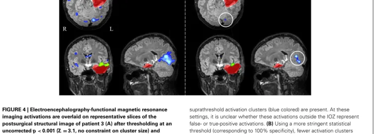 FIGURE 4 | Electroencephalography-functional magnetic resonance imaging activations are overlaid on representative slices of the postsurgical structural image of patient 3 (A) after thresholding at an uncorrected p < 0.001 (Z = 3.1, no constraint on clu