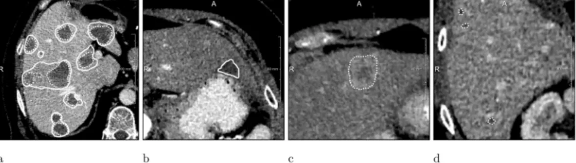 Figure 3.  MTRA (dashed) vs. LiTS (solid) annotations. (a) Case with low dice/correspondence (b) Case where  a LiTS reference tumor was missed (c) Case where MTRA found a lesion in a case with no tumors according to  LiTS reference (d) Case where small add