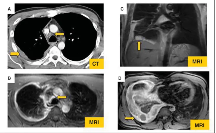Fig 1 illustrates some of the findings typically seen on imaging studies in MPM. Positron emission  tomogra-phy (PET) may offer some additional information in the staging of MPM since it reliably detects  contralat-eral chest involvement and extrathoracic 