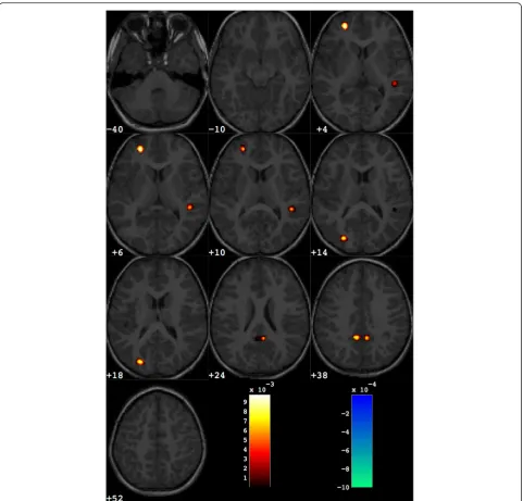 Table 4 Grey matter regions that discriminate between the groups of ASD and control subjects for male subjects