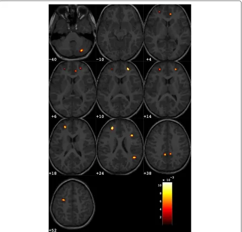 Fig. 4 Discrimination map highlighting the differences between female subjects with ASD from matched controls, obtained retaining about 1000out of the total amount of grey matter voxels