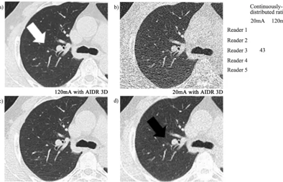 Fig. 7. Trans-axial images at the right upper lobe in an 83-year-old man with a body mass index of 22.0