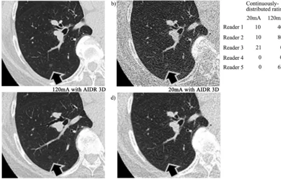 Fig. 9. Trans-axial images at the right lower lobe in a 62-year-old man with a body mass index of 29.1