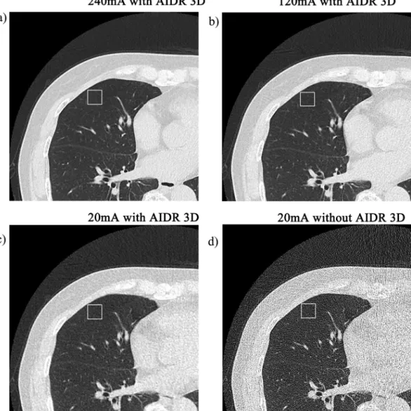 Fig. 2. This is an example of objective image noise measurement in the level of right inferior pulmonary vein (71-year-old woman)