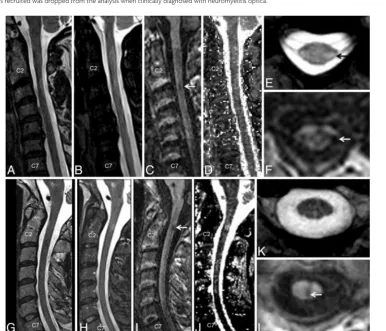 FIG 1. A comparison of imaging techniques for visualization of cervical cord lesions in a 45-year-old woman ((lesions were also visible on axially reformatted T1-MPRAGE images ((A–F) and a 43-year-old man (G–L),both with relapsing-remitting MS