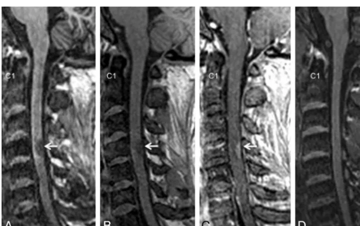 FIG 2. A comparison of imaging techniques for visualization of thoracic cord lesions in a 45-year-old woman with relapsing-remitting MS