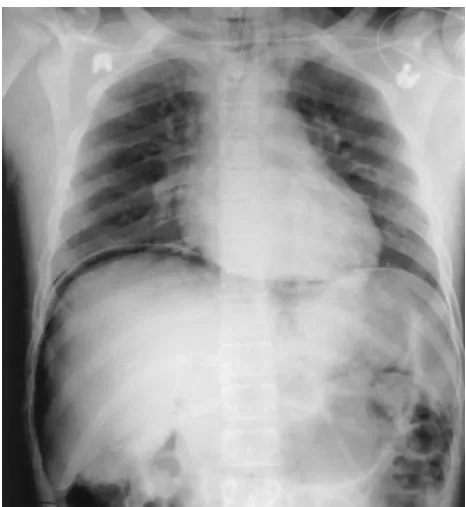 Fig 2. Postoperative upper GI series in the prone position, show-ing irregularity at the sutured perforation site along the lessercurvature (arrow).
