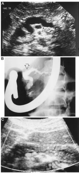 Fig 1. A, An ultrasound scan demonstratinggross distention of the pancreatic duct (arrow)before stenting
