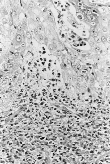 Fig 2. Skin biopsy revealing a dense band-like inflammatory in-filtrate composed predominantly of neutrophils with occasionalmacrophages, lymphocytes, and eosinophils associated with der-mal edema and predominantly involving the upper dermis (he-matoxylin-eosin, �100).